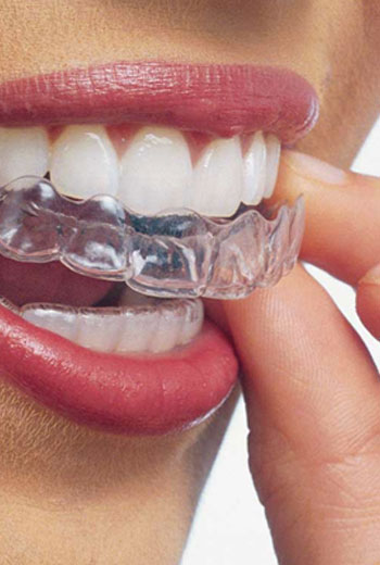 Invisalign, Austin Heights Dental