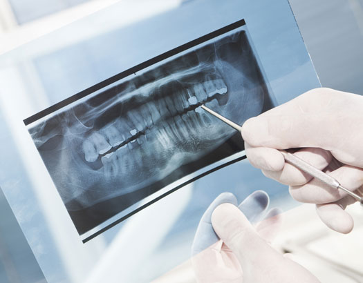 Dental Xrays, Dentist Coquitlam